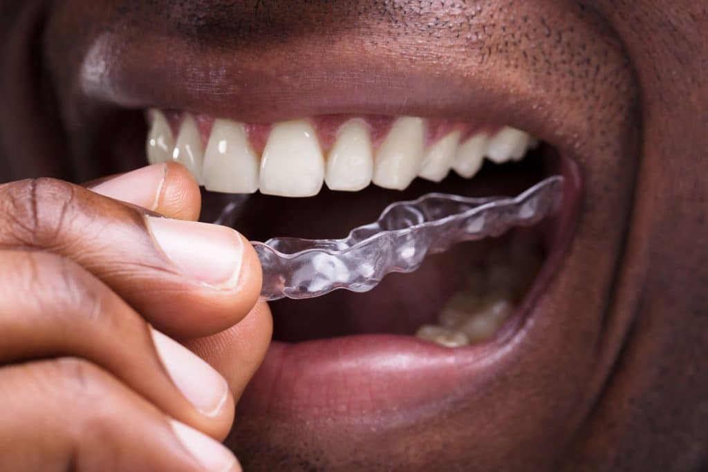 The Top Benefits of Invisalign for Adults