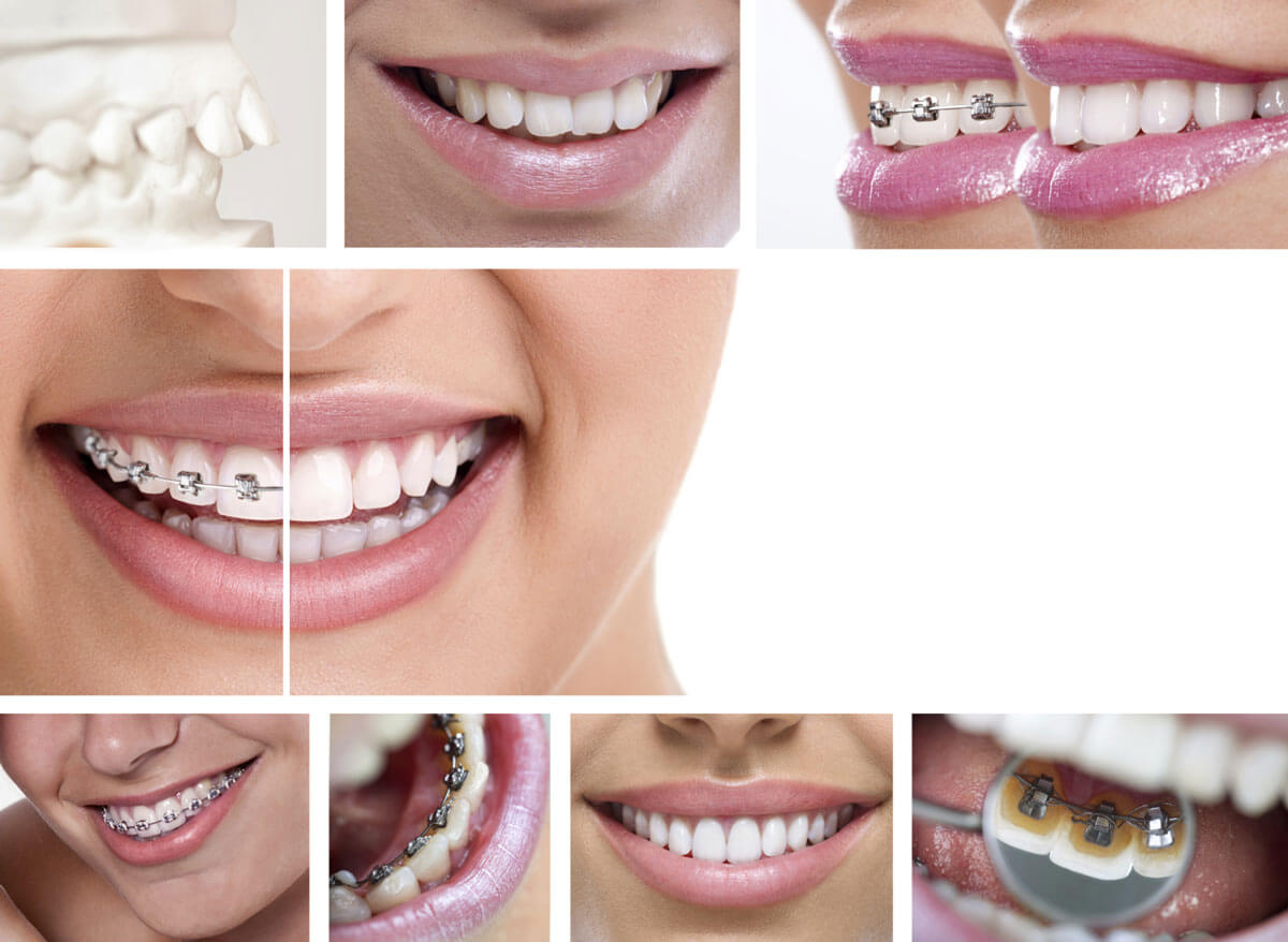 Invisalign Treatment from a General Dentist for Alignment or