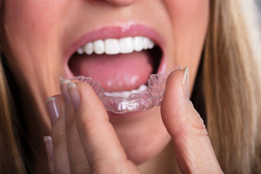 Why Invisalign is the Ideal Choice for Adults